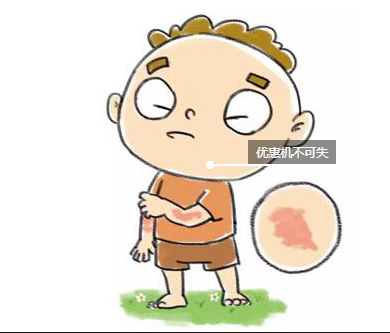 少年兒童患特應(yīng)性皮炎